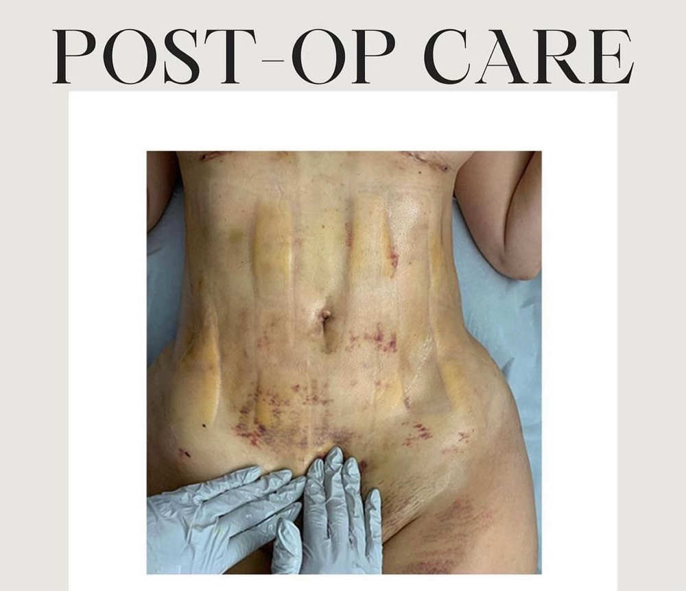Post OP Lympathic Drainage Massage