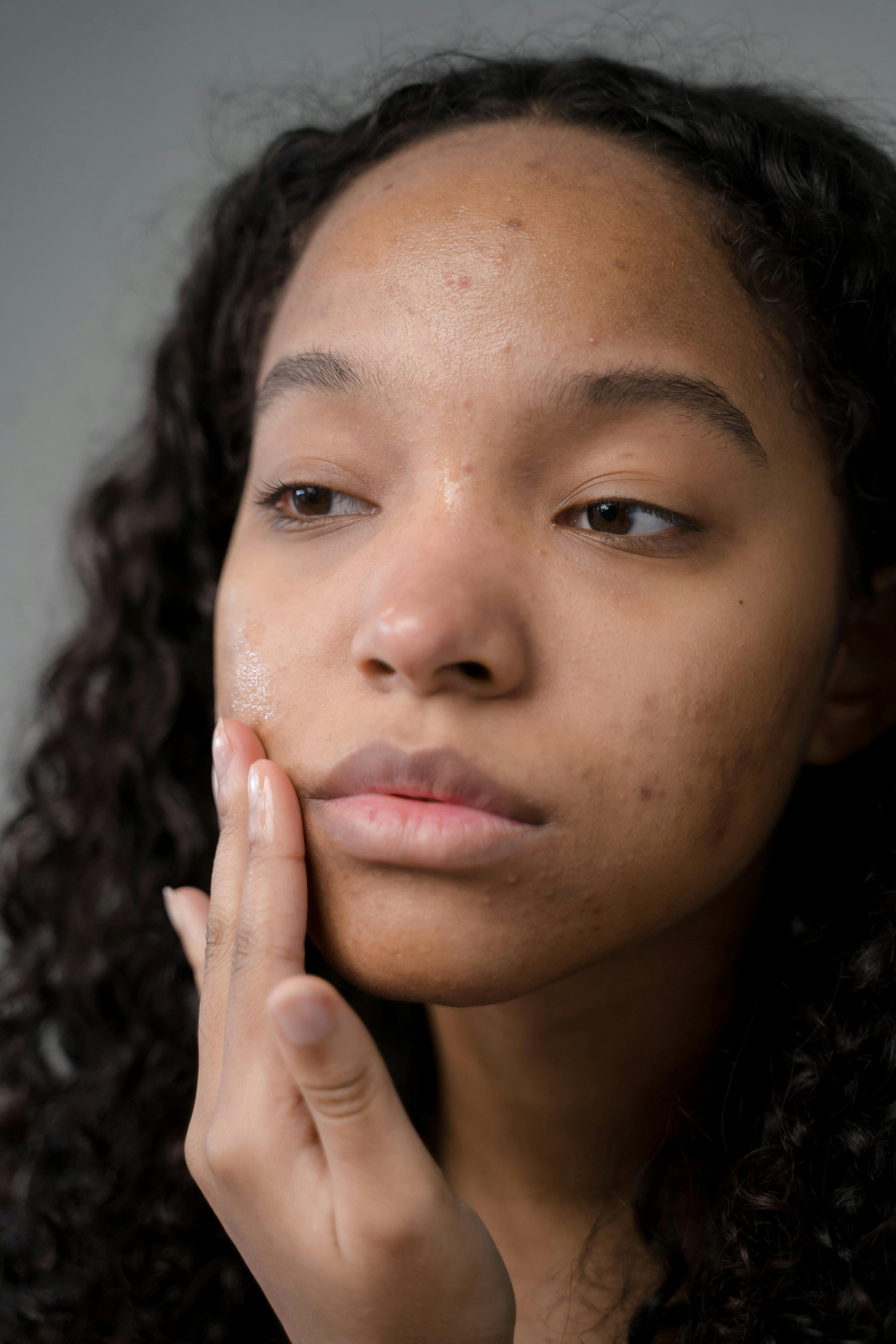 Simply Acne Treatment