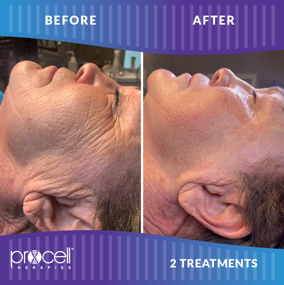 Procell Microchanneling (Face)