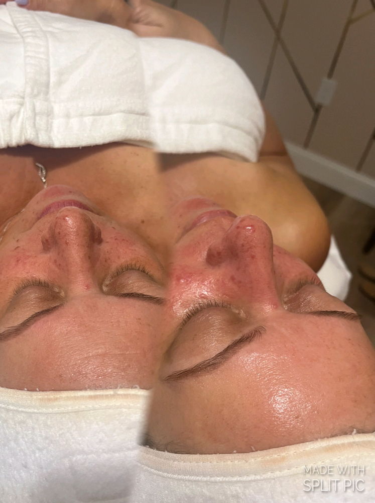 Needle Free Filler Facial