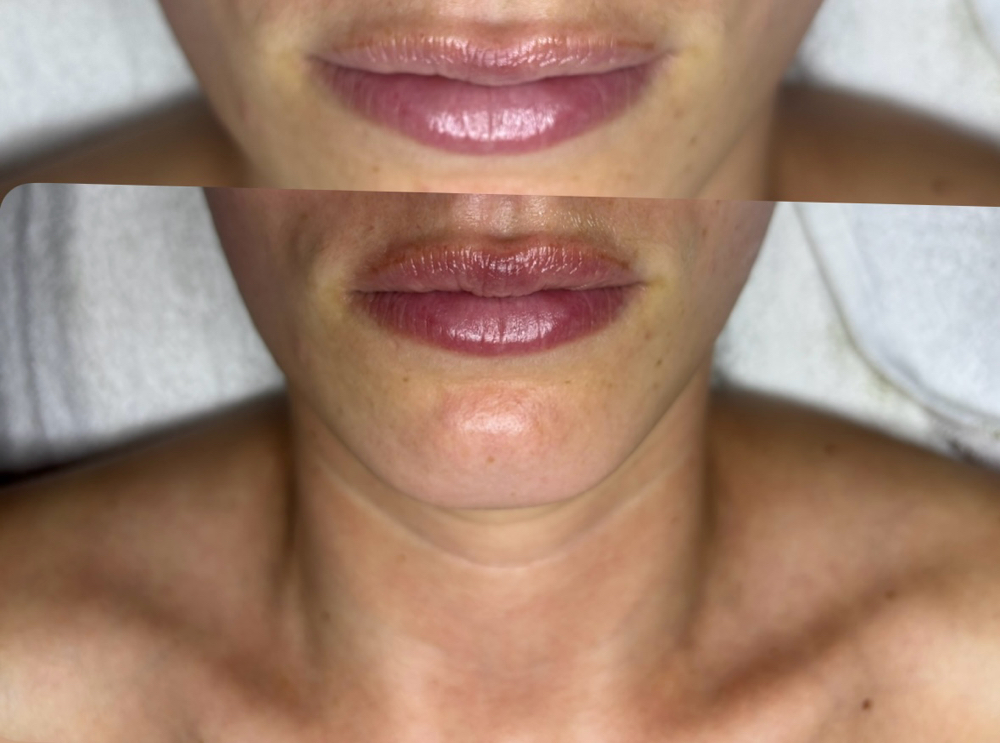 Needleless Lip Filler at Skin Tender in Ventura, CA
