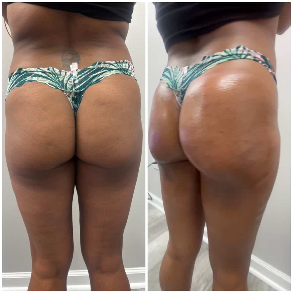 LIQUID BBL INJECTIONS