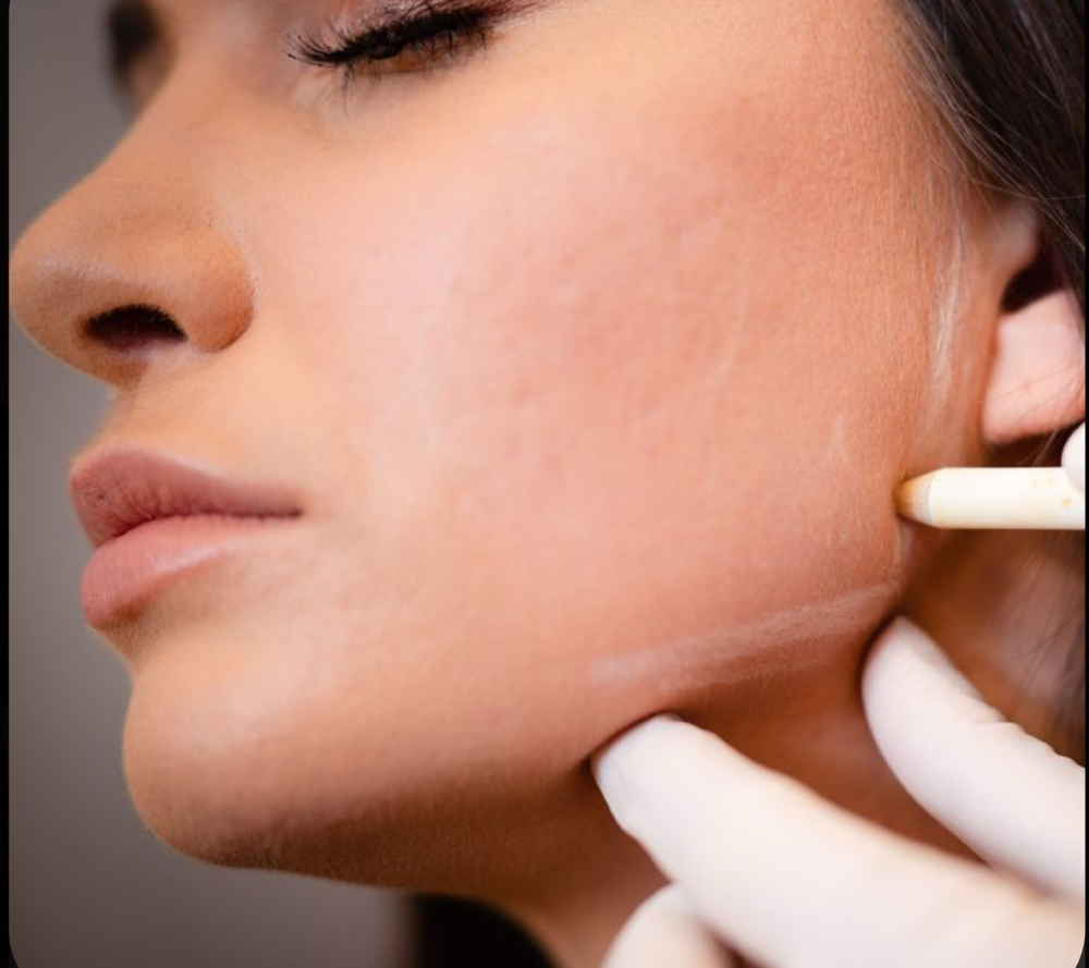 ✨Jawline Lipolysis✨