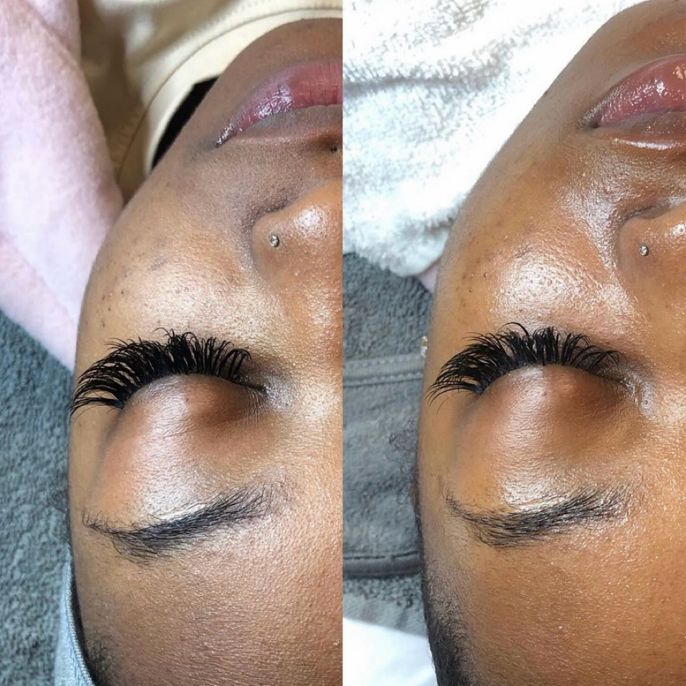 Microdermabrasion at Skin Therapy in Golden valley, MN