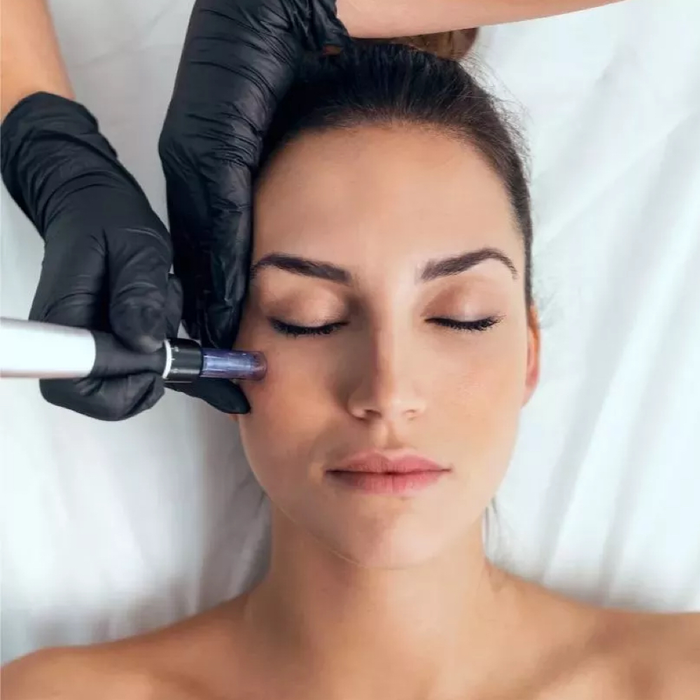 Microneedling (Face+Neck) at Skin by Cydni in Atlanta, GA