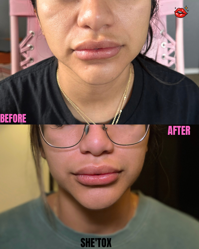 Lower Face Slimming ✨