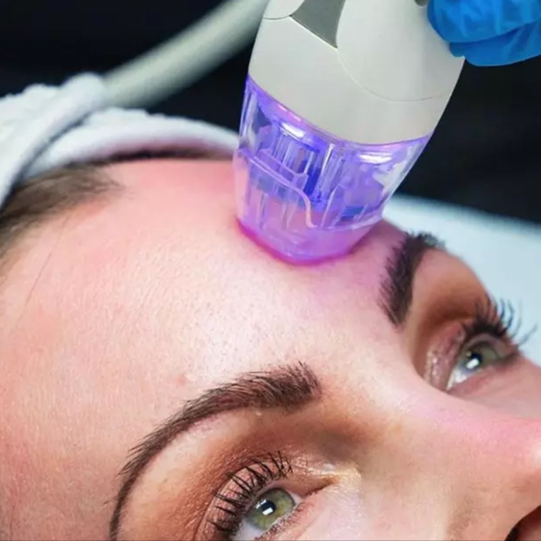 Micro Needling at Bliss Beauty Bar in Houston, TX