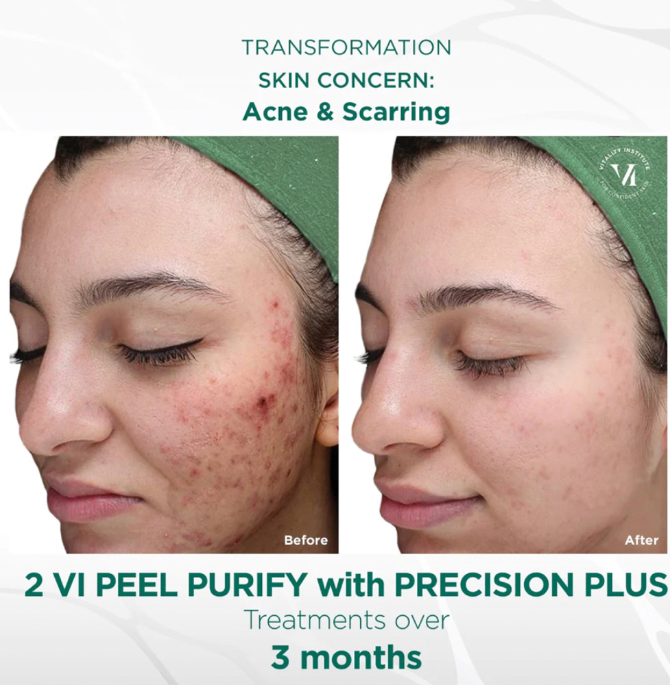 Vi Peel Purify with Precision Plus