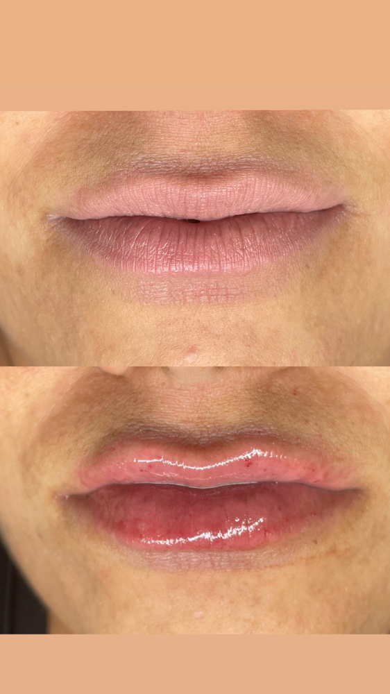 Hyaluronic Lips