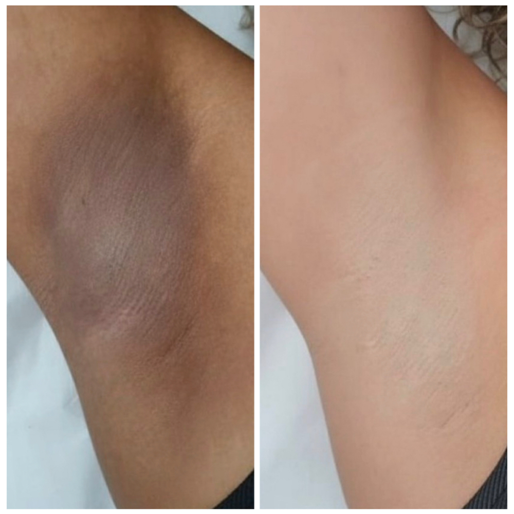 Underarm Bleaching at NICHÉ in Lewisville, TX