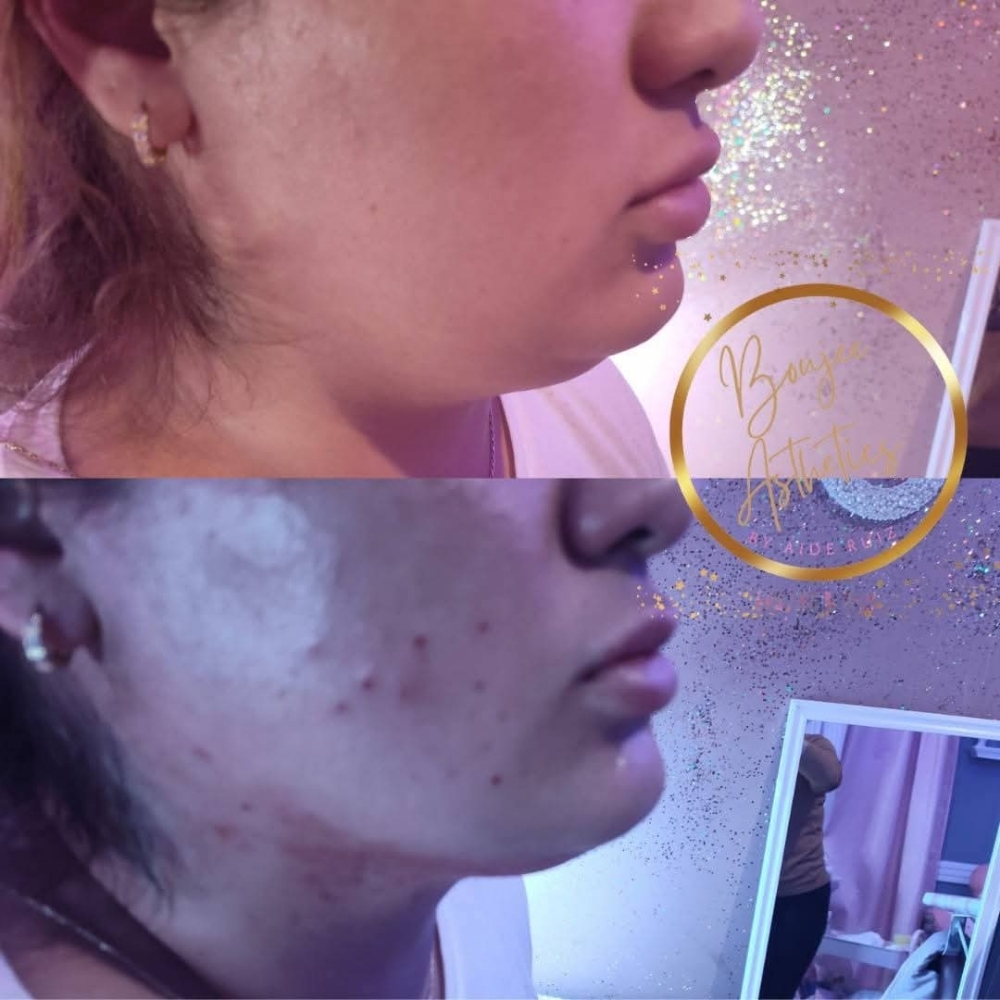Double Chin LIPO SHOTS 🪄 at Boujee Asthetics ✨ in Tucson, AZ