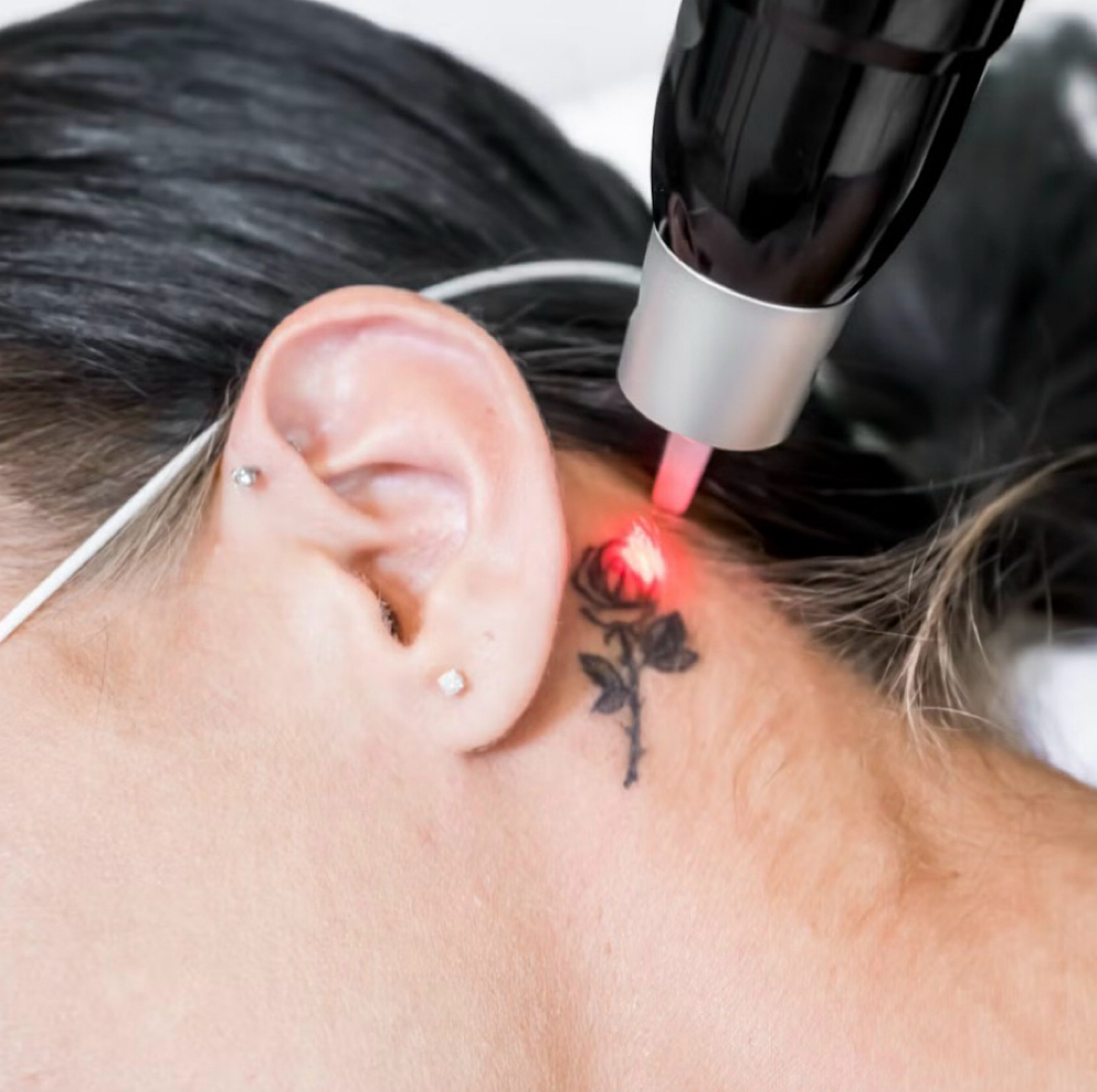 Laser Tattoo Removal - Small Area at NICHÉ in Lewisville, TX