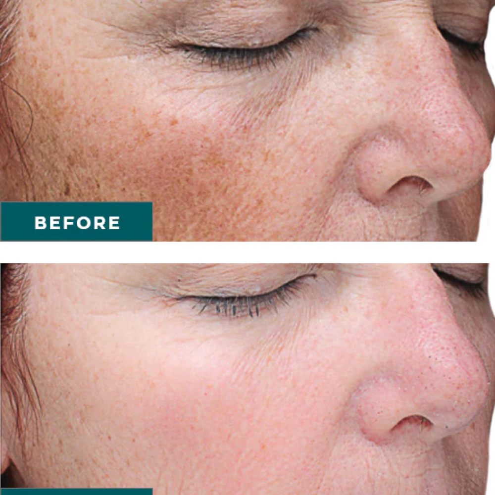 July Medical Grade Chemical Peel at Monroe’s Everlasting Beauty in Corpus Christi, TX