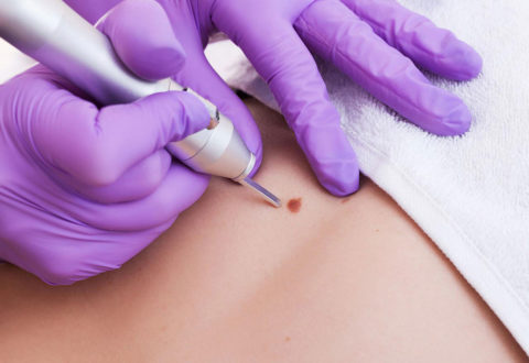 Skin Tag / Mole Removal