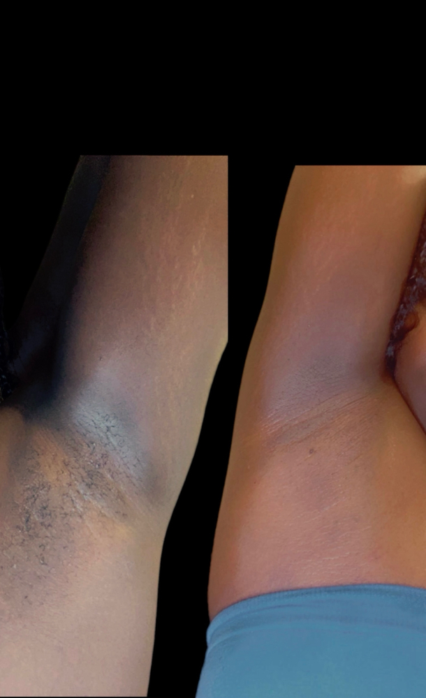 Underarm Wax w/ Chemical Peel