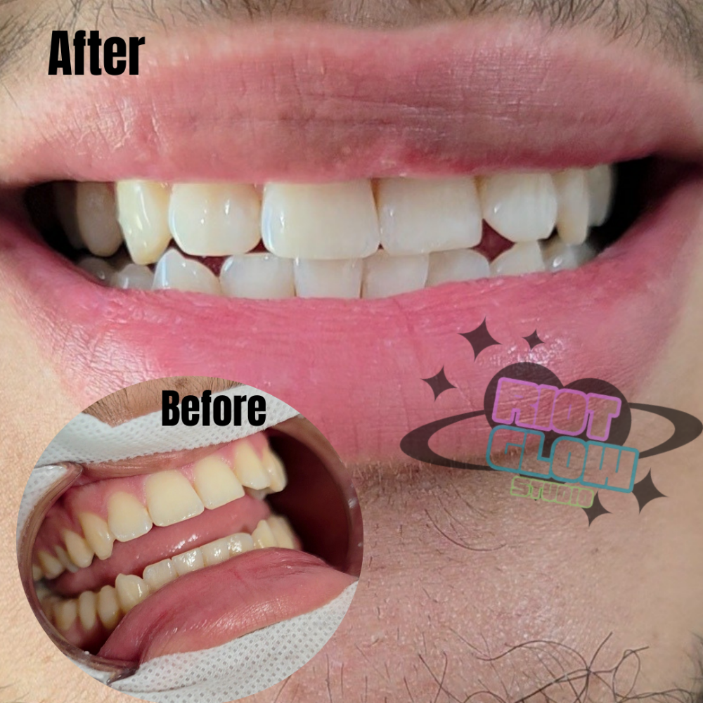 30 Min TEETH WHITENING