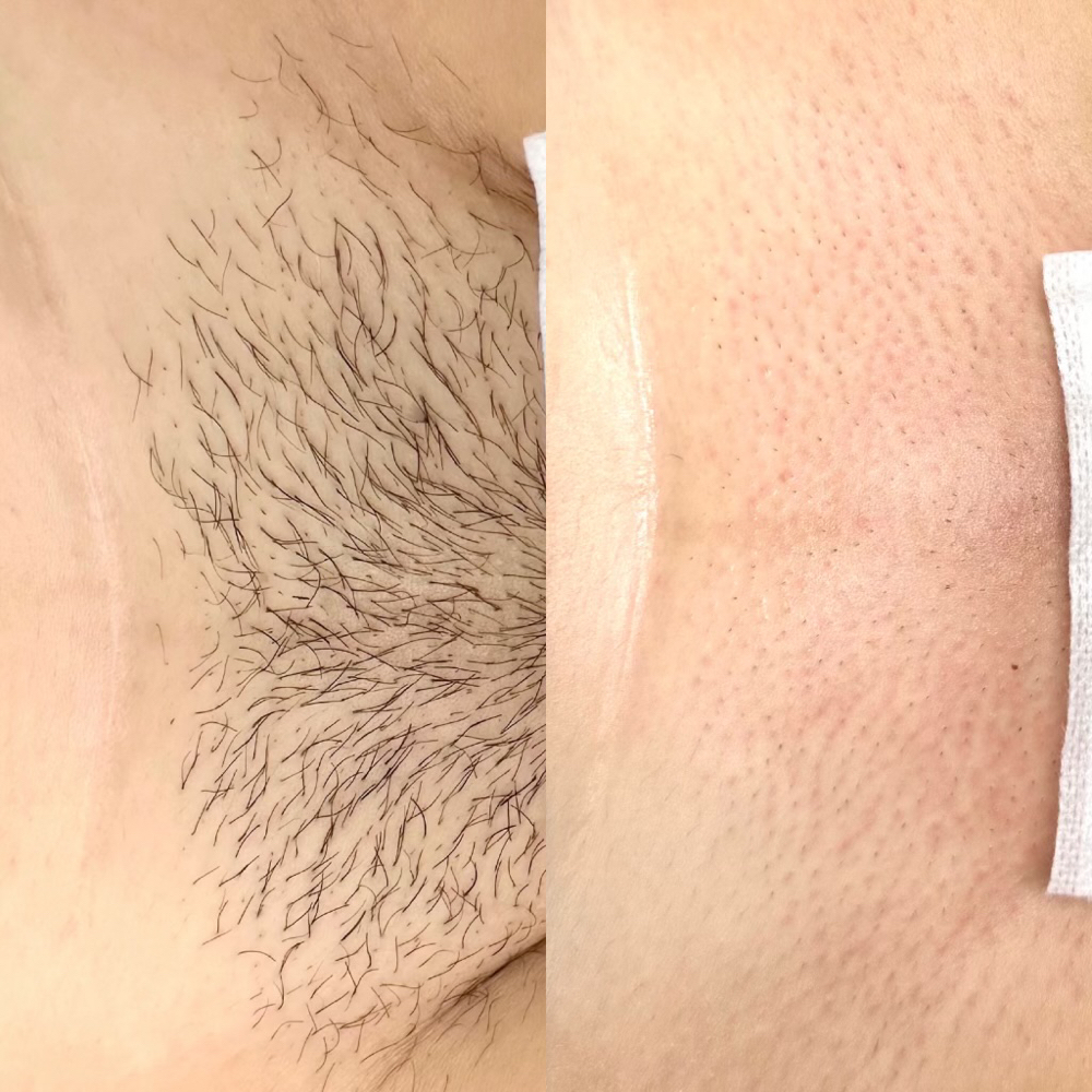 Brazilian Wax