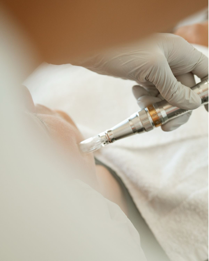 ✨ 🌱Microneedle Facial Treatment