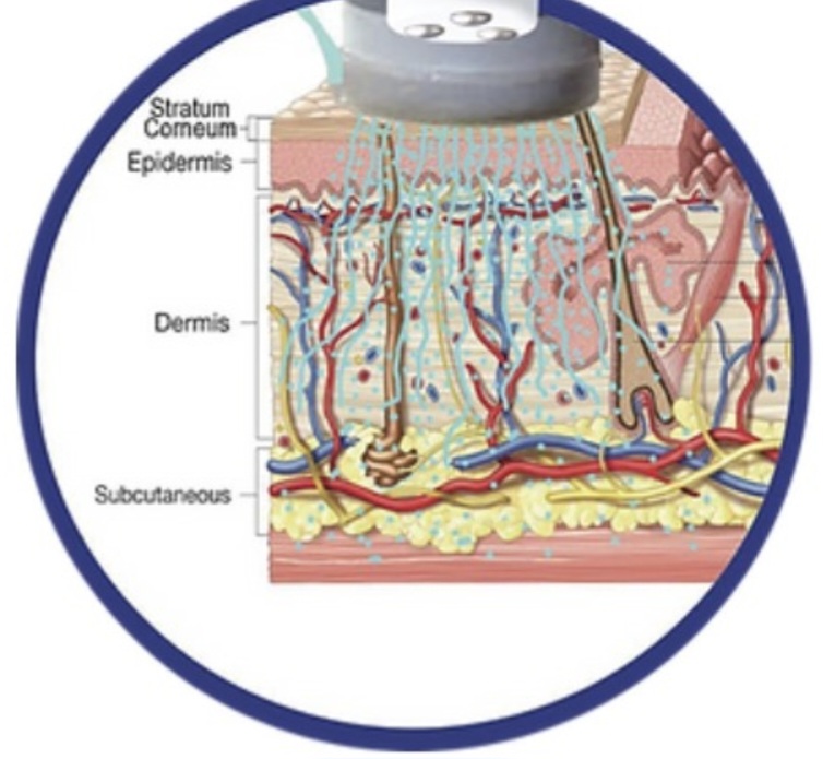 Dermoelectroporation Treatment