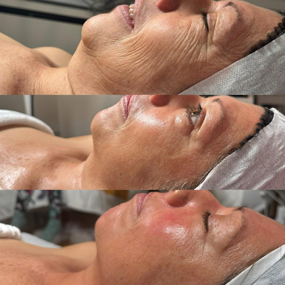 Microneedling 3 Session Reboost