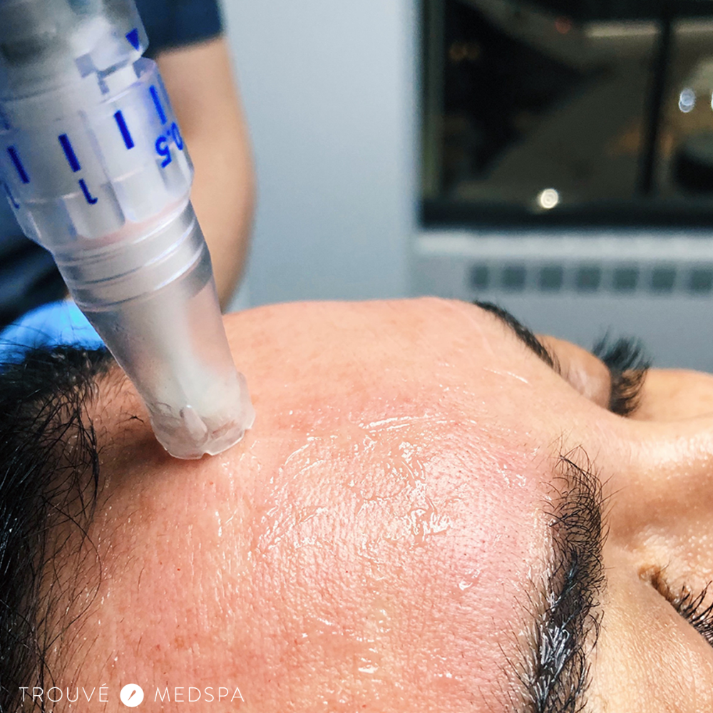 Microneedling With Stem Cell at Bella Glow Skin and Body in San Antonio, TX
