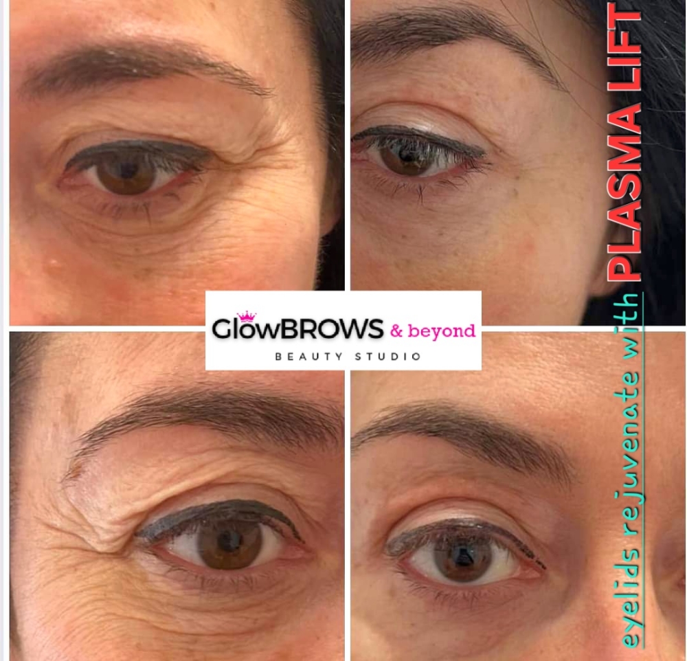 Upper Eyelids LIFT by Plasma