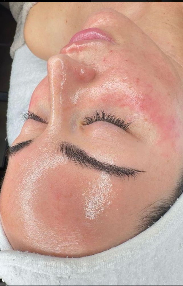 Chemical Peel | Peeling Quimico
