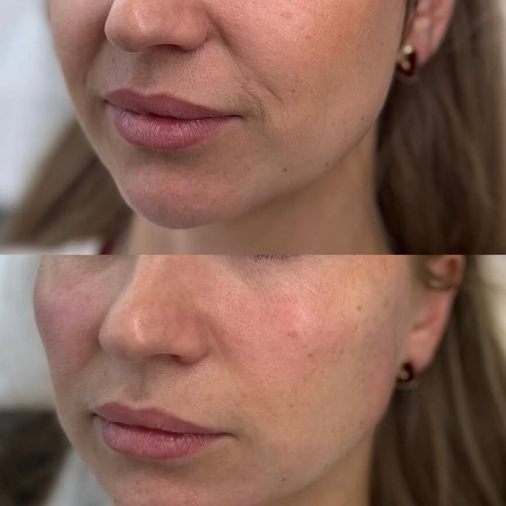 Nasolabial Fold Filler / Smile Line at La Belle Aesthetics & Wellness in Hellertown, PA