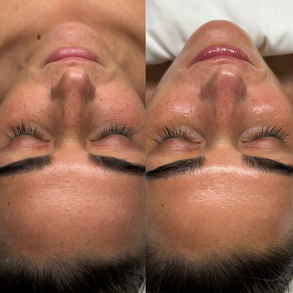 Nano-Infusion Facial