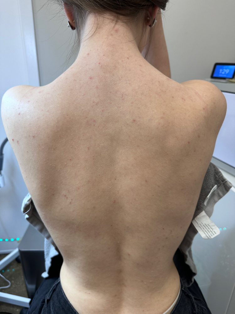 Back Facial