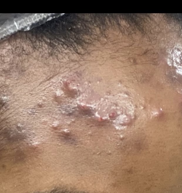 LA Rx Expert Cyst Flush + Drain