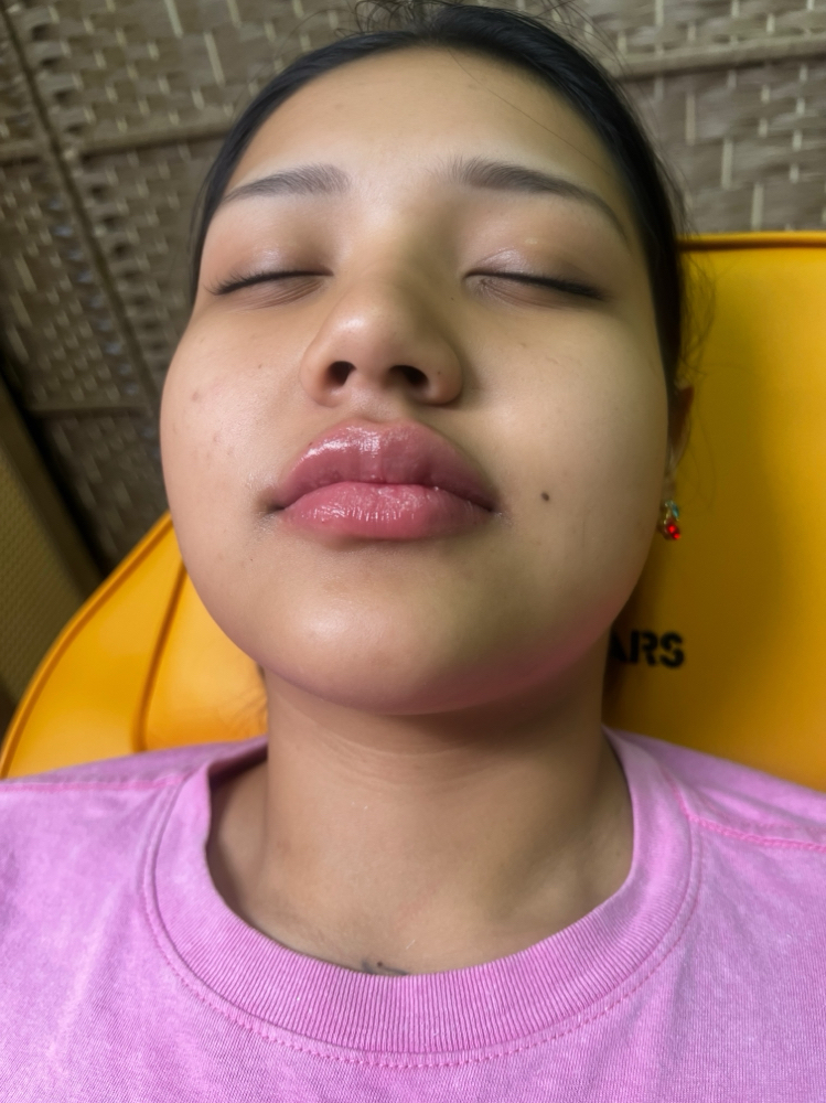 Full Lips With Revanesse