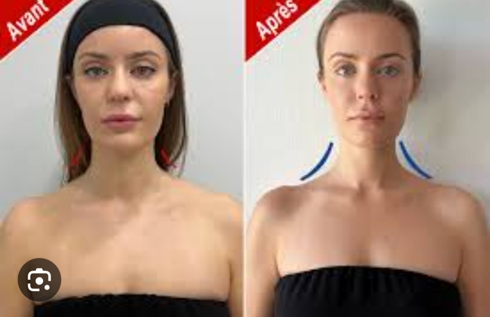 Barbie Botox -Trapezious Muscle