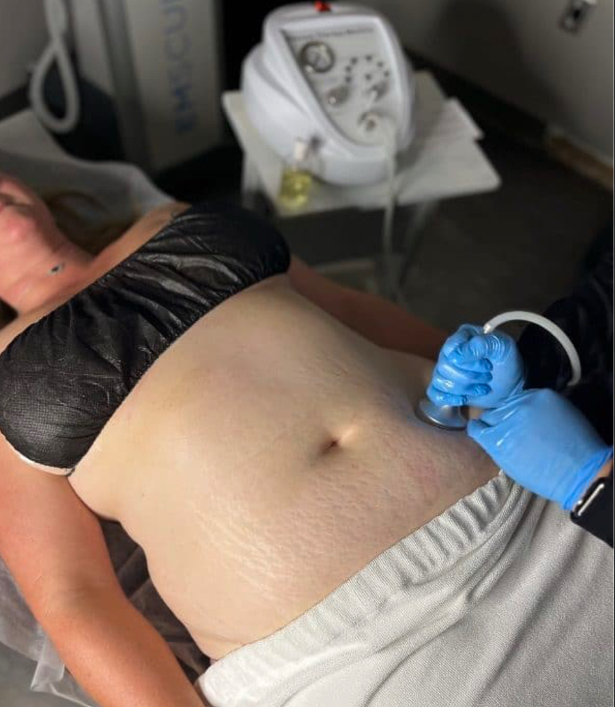 Post Surgery Medicupping Therapy