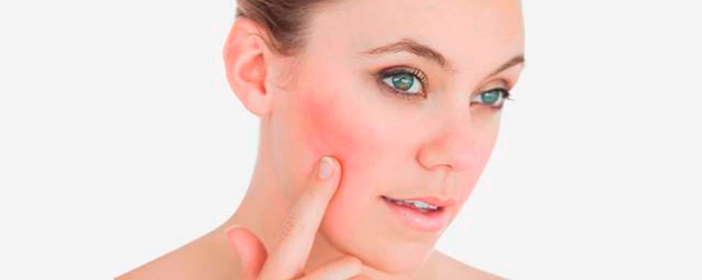Piel sensible / Rosacea