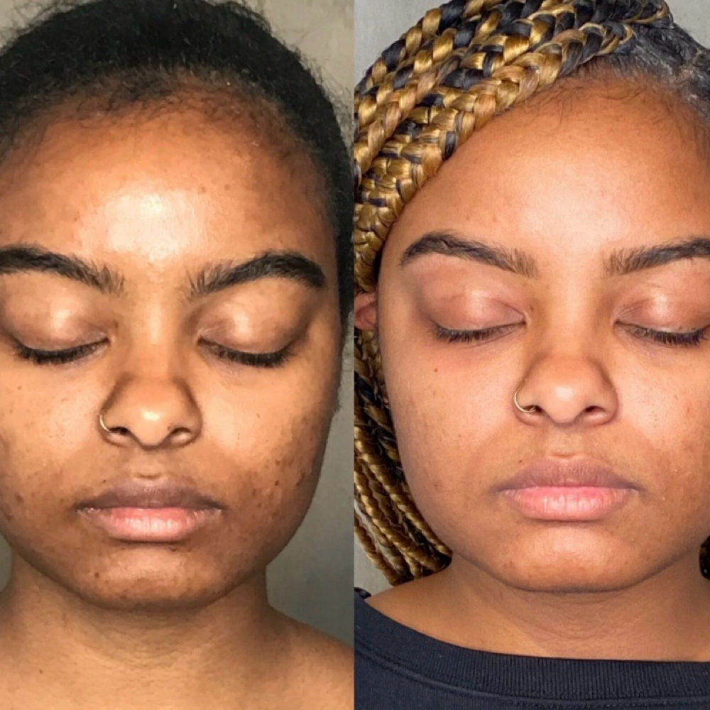 Clarifying Acne Facial at Glow & Behold in Durham, NC