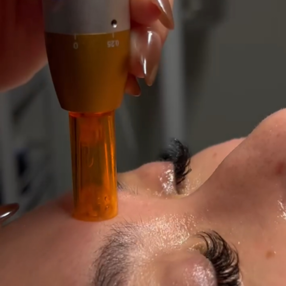 Nano-Needeling at Skin By Chelsey in Stockton, CA