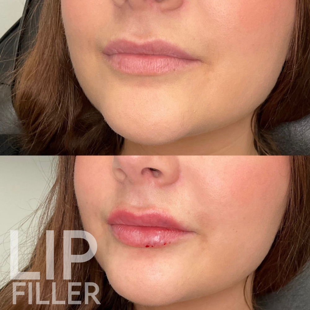 Mini Lip Filler