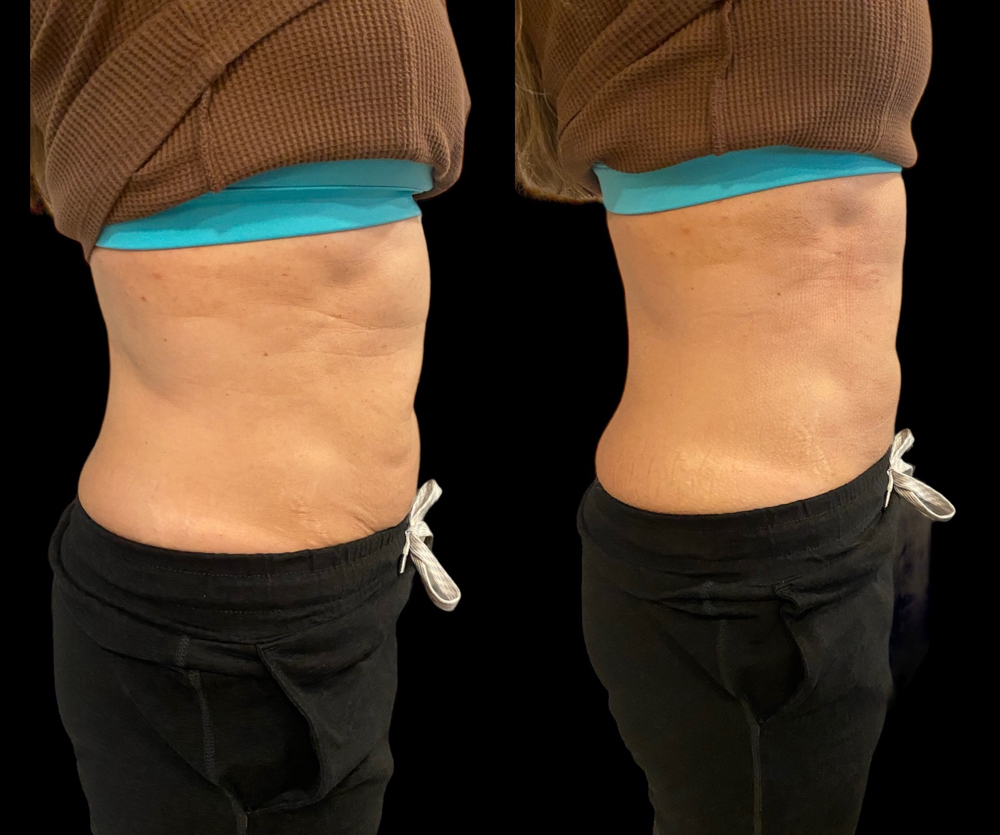 VIP Lipo Treatment