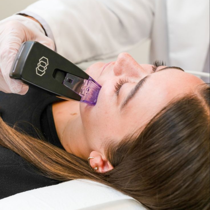 Morpheus8 Face+Neck at Luxe Level Aesthetics in Darien, CT