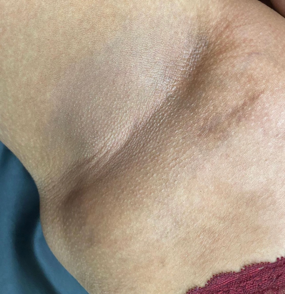 Underarms at Bare Esthetics & Wellness in Greenville, NC