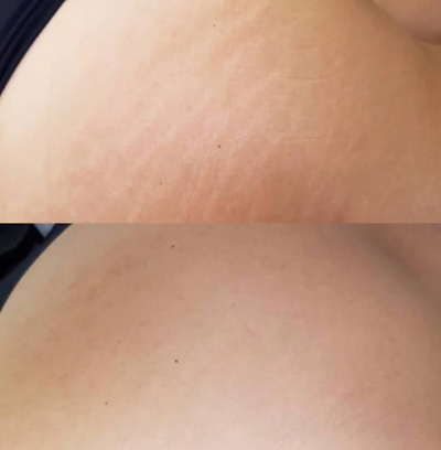 Inkless StretchMark Removal