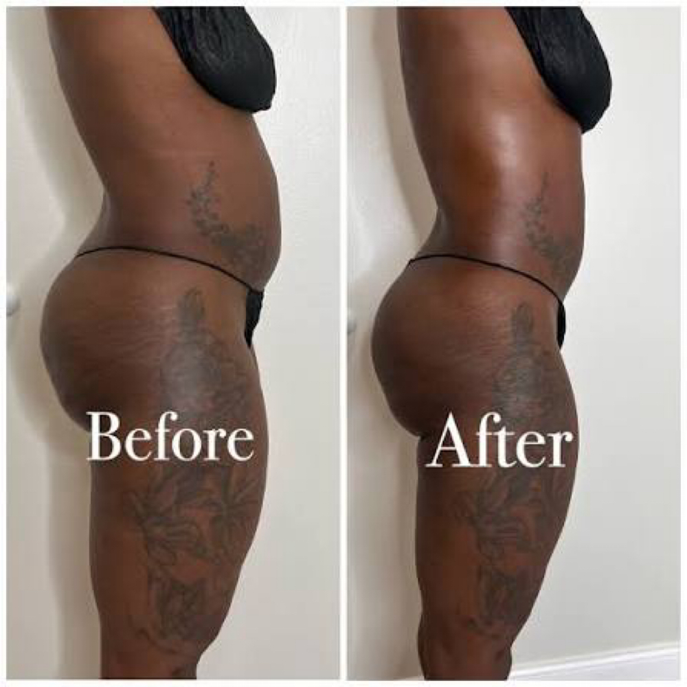 Cavitation 360 at Texas Top Tier Med Spa in Houston, TX