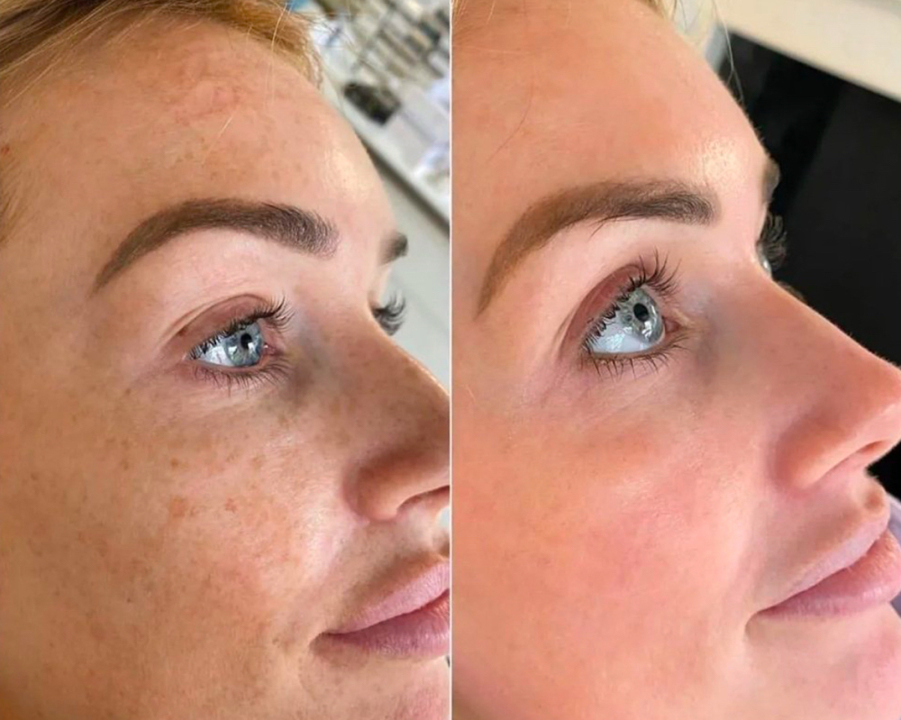 Cosmelan Peel (Introductory Price)