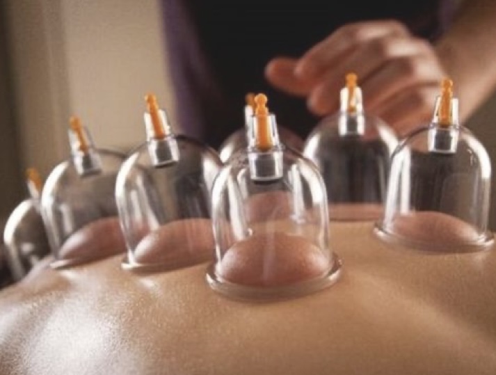 Cupping Therapy Massage