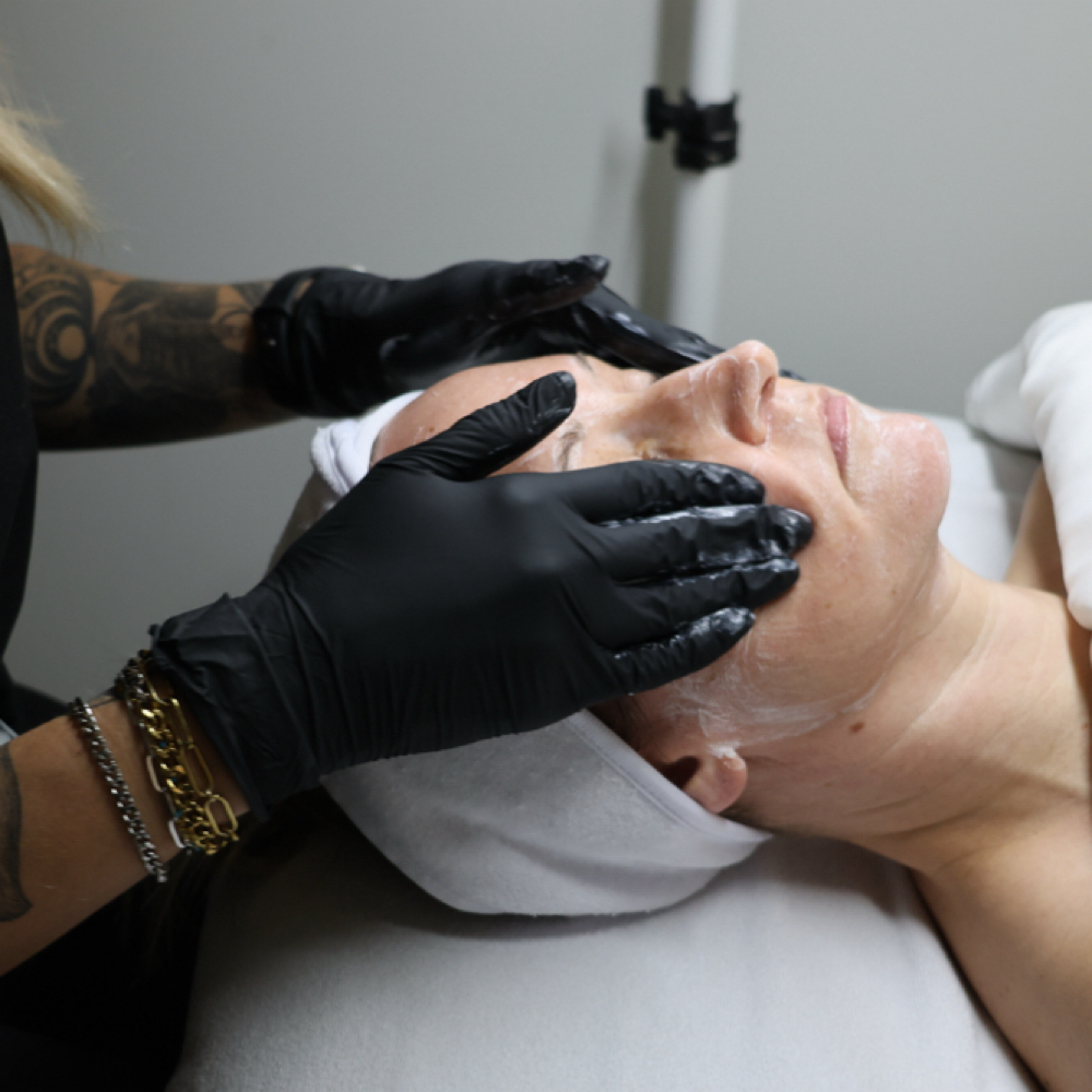 Microneedling at Mugshot Skincare in Omaha, NE