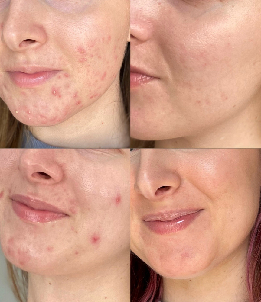 face reality acne bootcamp