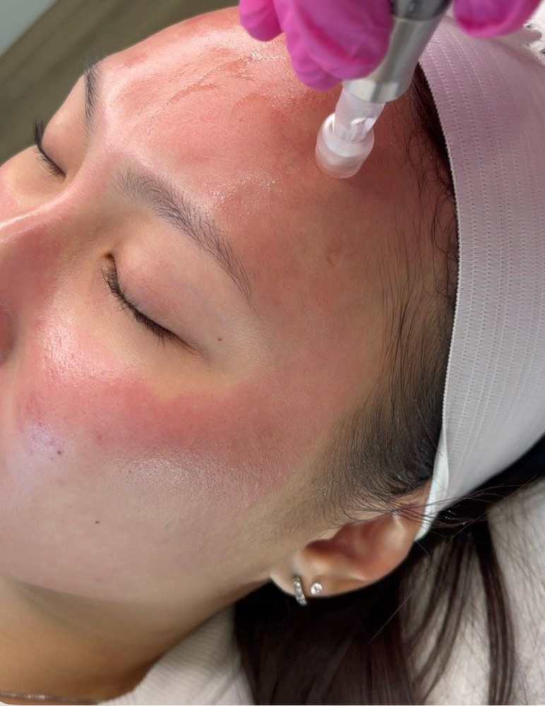Buy 1 Get 1 Free Microneedling