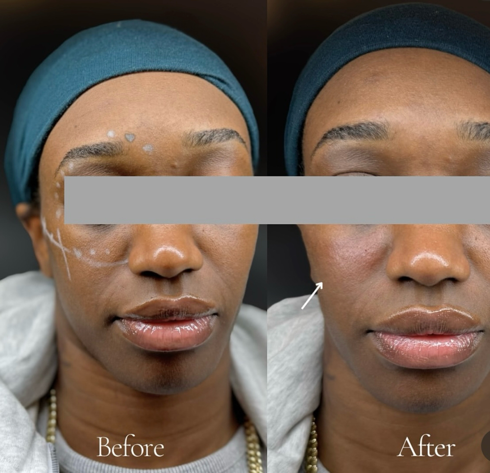 Cheek Filler