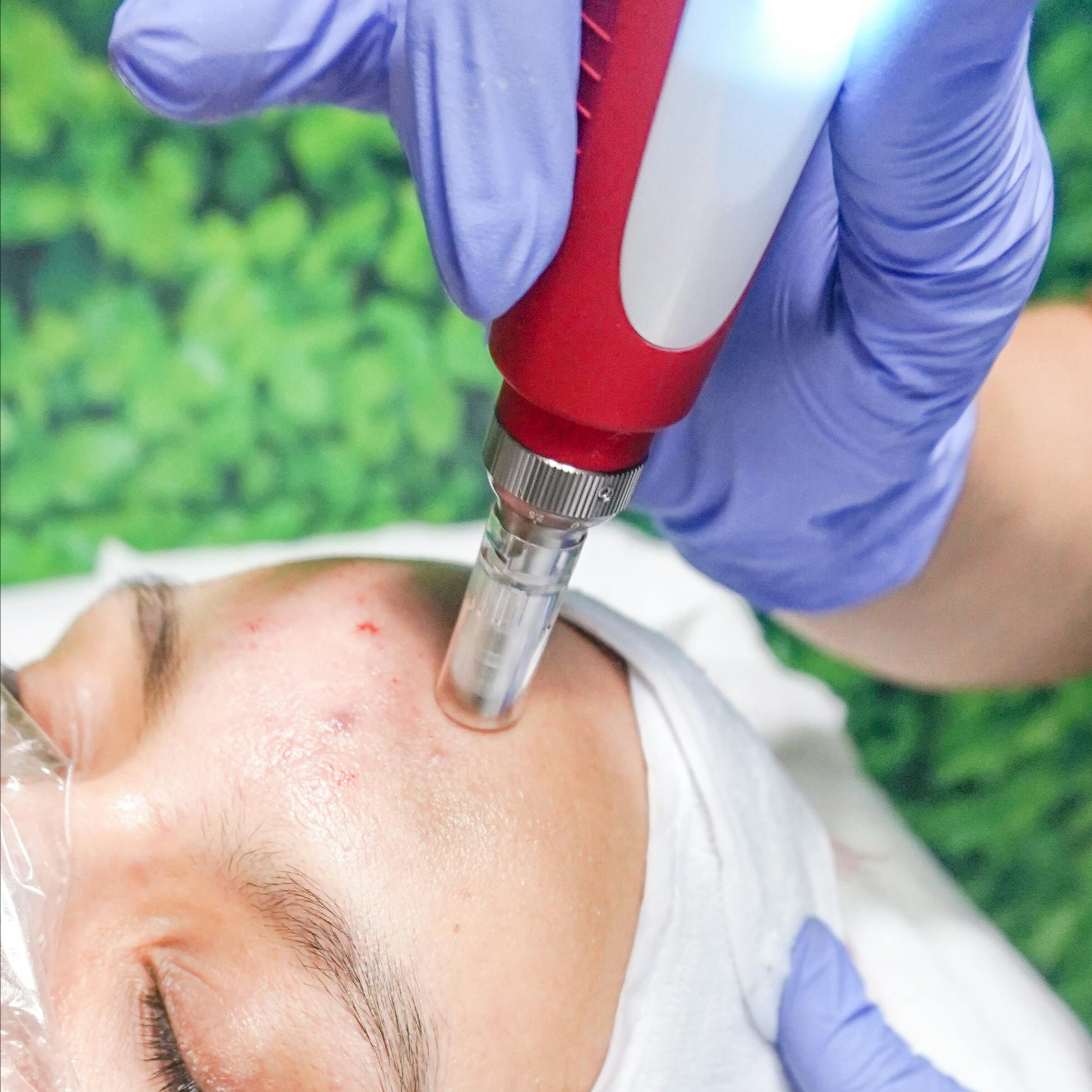 Microneedling at Radiant Recovery Spa and Beauty Bar in Charlotte, NC